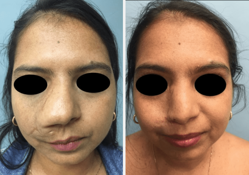 Neurofibromatosis McKinnon Plastic Surgery