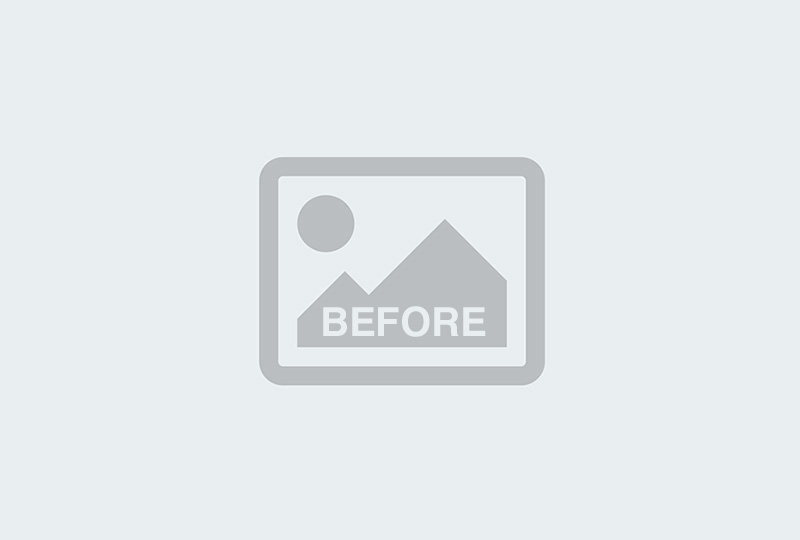 Before Image: Rhinoplasty, Genioplasty - back