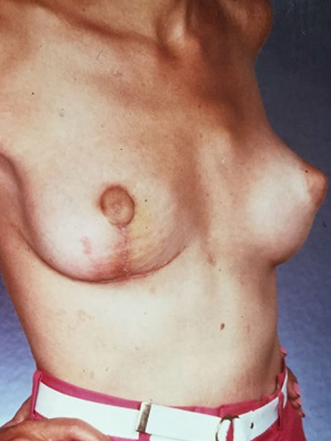 asymmetric breast reconstruction patient 1 after 4 cropped