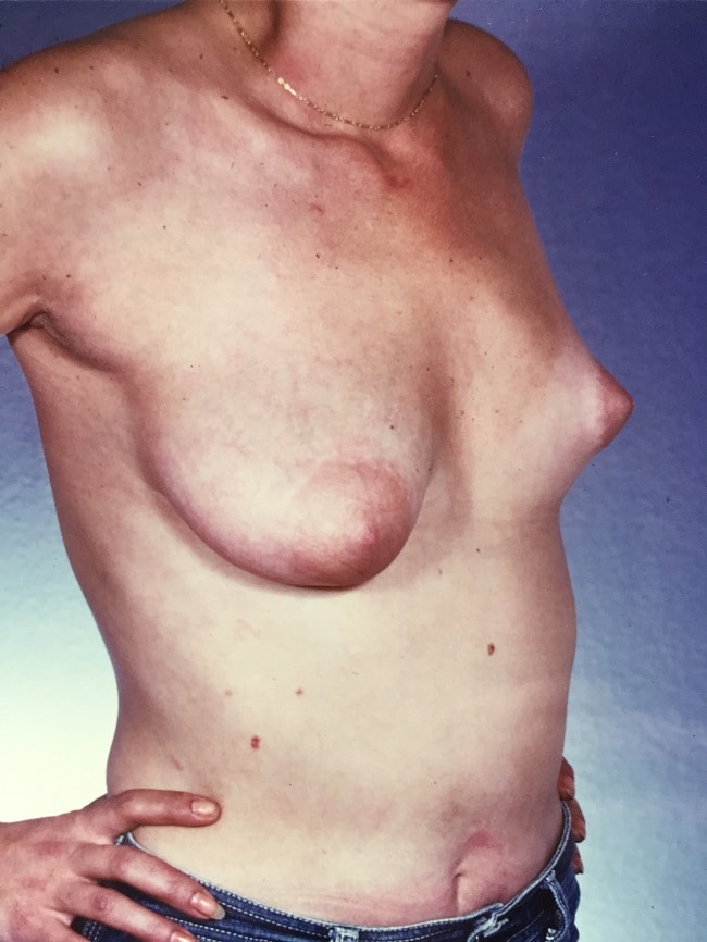 asymmetric breast reconstruction patient 1 before 3