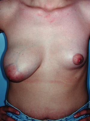 asymmetric breasts mastopexy right augmentation left patient 1 before 1 cropped