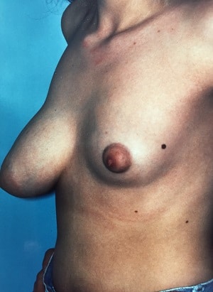 asymmetric breasts mastopexy right augmentation left patient 1 before side view cropped