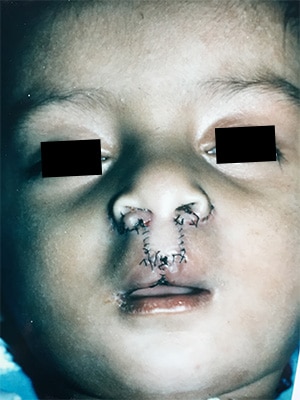 bilateral cleft lip patient 1 after front