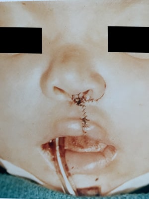 cleft lip unilateral patient 1 after front