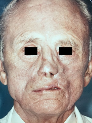 nasal reconstruction patient 1 after front