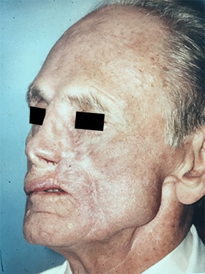 nasal reconstruction patient 1 after left