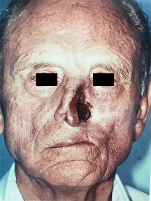 nasal reconstruction patient 1 before front