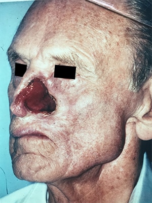 nasal reconstruction patient 1 before left