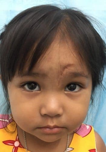 A young child with dark hair and a serious expression looks directly at the camera. The child has a noticeable scar on their forehead and is wearing a colorful shirt.