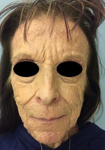 Close-up of a person with a skin condition, showing deep wrinkles and texture on the face. Eyes are blacked out for anonymity.