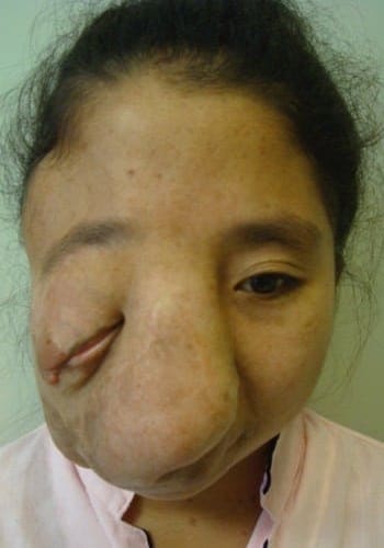 A person with a severe facial deformity, causing significant enlargement around the nose and left eye.