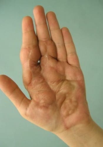 A close-up of an open palm with visible skin pigmentation differences, showing darker areas around the fingers and lighter in the center.