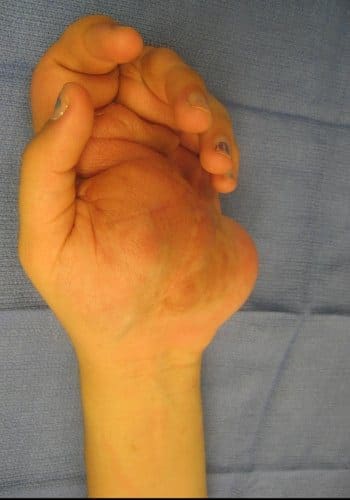 A hand with visible swelling or deformity is resting on a blue fabric surface.