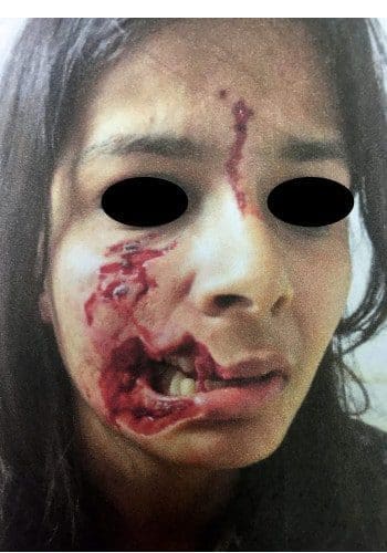 A person's face is visibly injured with blood and bruises on their cheek and forehead. Their eyes are censored, and they appear distressed.