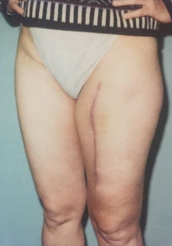 The image shows a person standing with hands on hips, revealing a vertical surgical scar on their right thigh, extending from the upper thigh to above the knee, wearing light-colored underwear and a sweater.