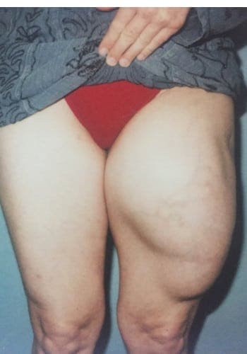 An individual shows one leg with significant swelling compared to the other. They are wearing red briefs and a patterned top lifted slightly to expose the upper thighs.