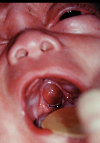 Close-up view of an inside of a mouth showing an inflamed mass on the tonsils, with a wooden tongue depressor visible.