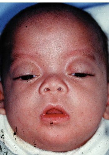 Close-up of an infant's face showing noticeable facial features and expression. The infant's eyes are partially open, and the mouth is slightly ajar. The baby is wearing a white garment.