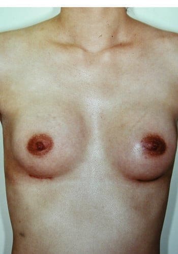 Upper body of a topless person with visible tan lines around the chest area.