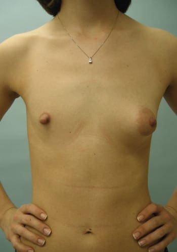 A topless person with visible breast implants and scars stands against a plain background with hands on hips, wearing a necklace.