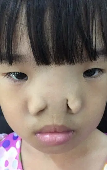 A close-up of a young child with a flat nose bridge and a facial deformity wearing a pink top with a polka dot pattern.