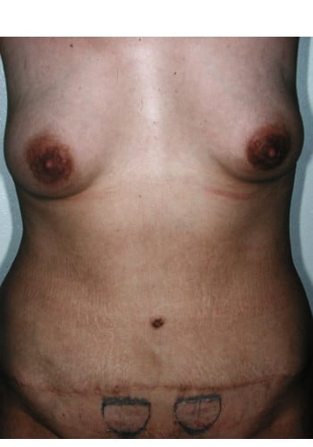 A woman with breast implants is shown in this picture.