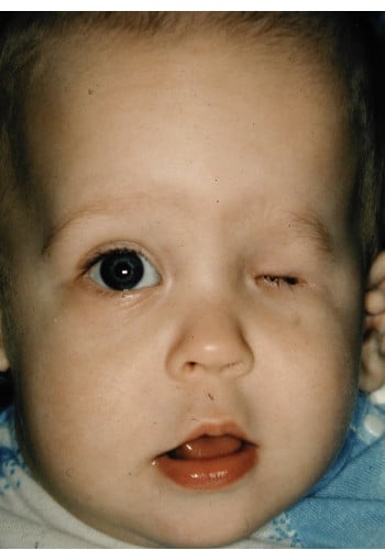 A baby with an eye injury is shown.