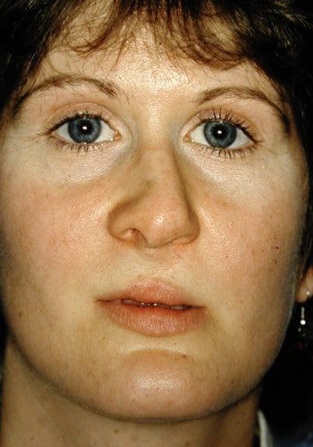 Before Image: Cleft Rhinoplasty - front