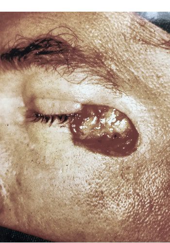 Close-up of eye with skin lesion.