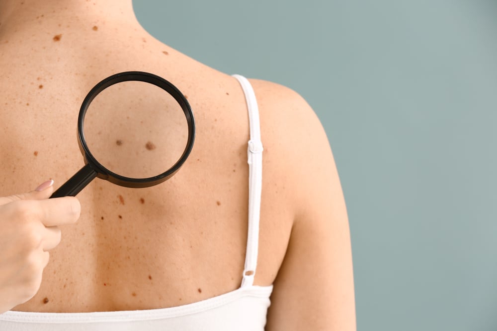 Dermatologist,Examining,Moles,Of,Patient,On,Grey,Background