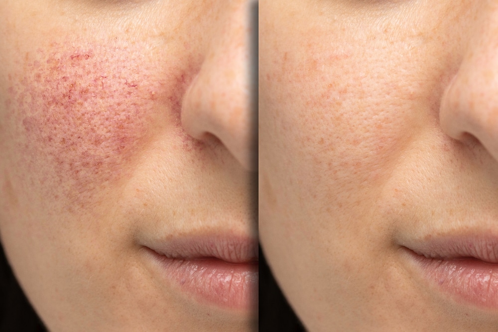 Before,And,After,Laser,Treatment,For,Rosacea,,Couperose.,Successful,Intervention