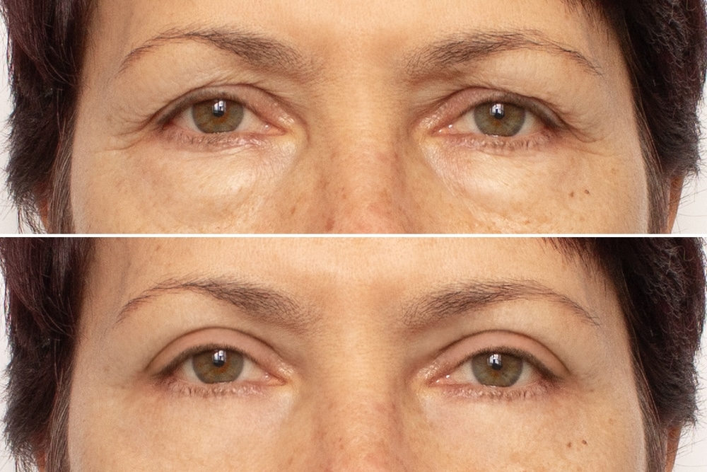 Close-up,Of,An,Elderly,Woman's,Eyes,Before,And,After,Blepharoplasty.