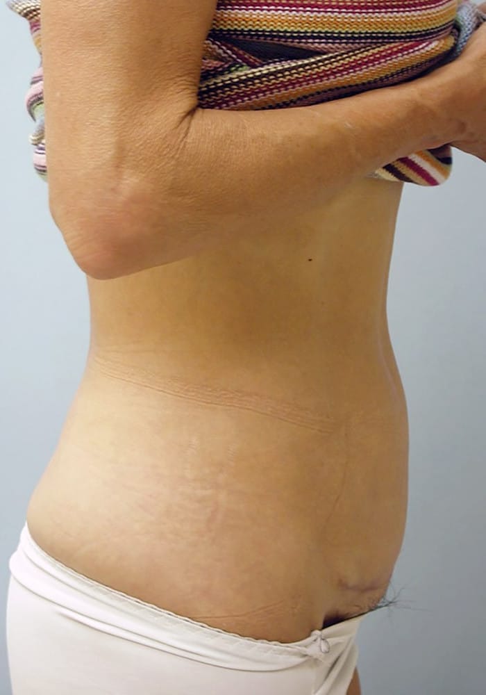 After Image: Abdominoplasty - right-side
