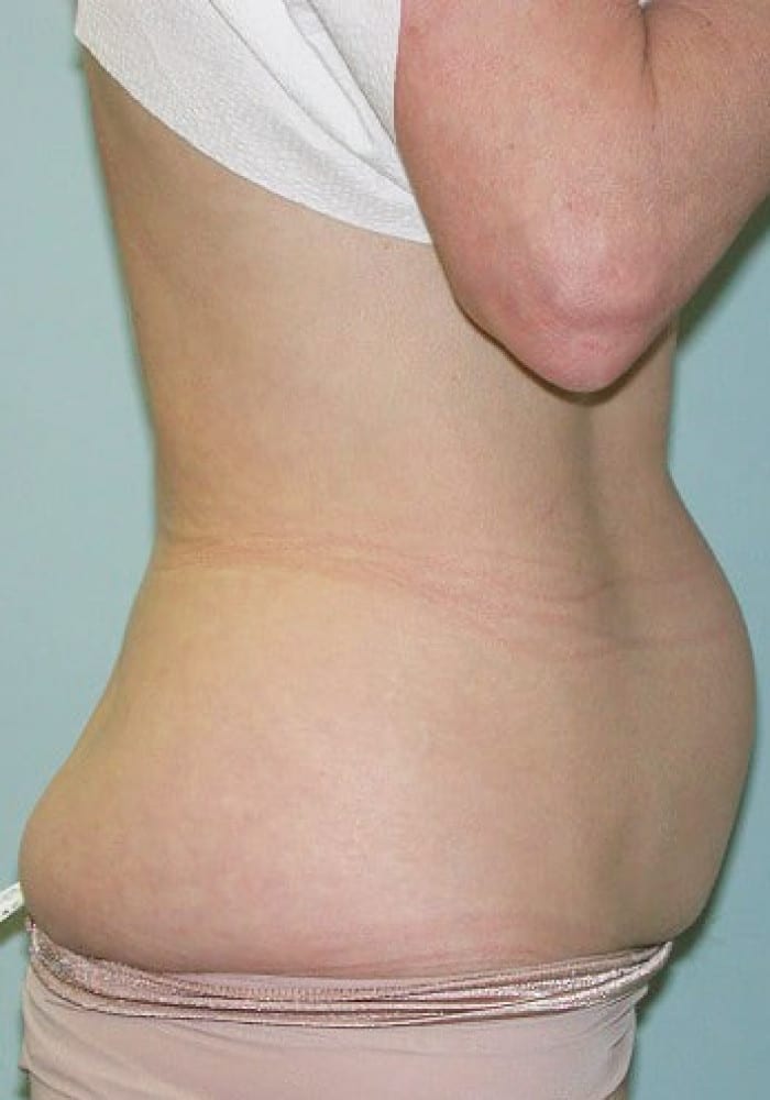 Before Image: Abdominoplasty - right-side