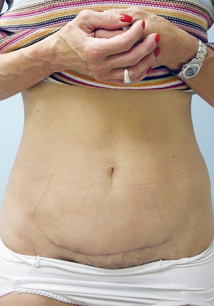 After Image: Abdominoplasty - front