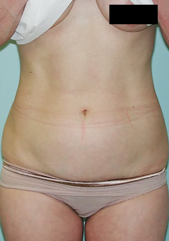 Before Image: Abdominoplasty - front