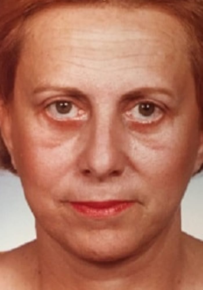 After Image: Blepharoplasty & Facelift - front
