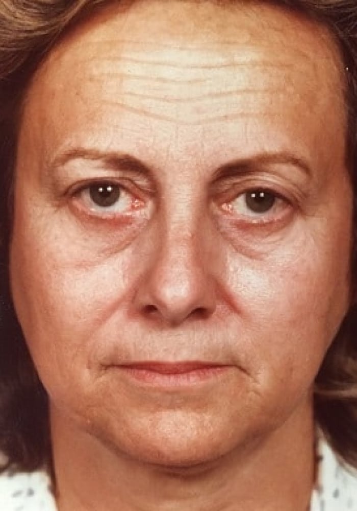 Before Image: Blepharoplasty & Facelift - front