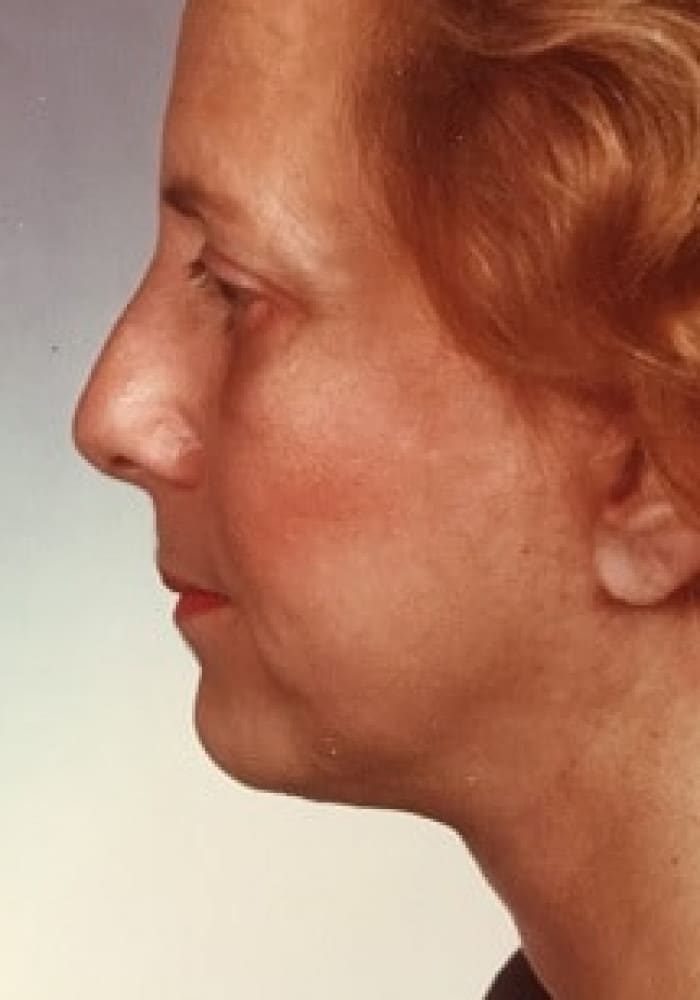 After Image: Blepharoplasty & Facelift - left-side