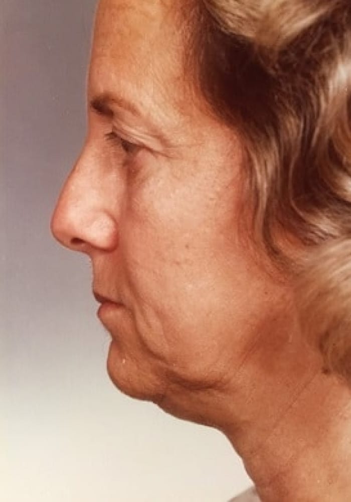 Before Image: Blepharoplasty & Facelift - left-side