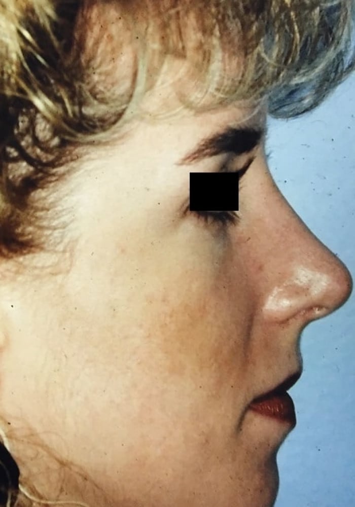 After Image: Rhinoplasty - right-side