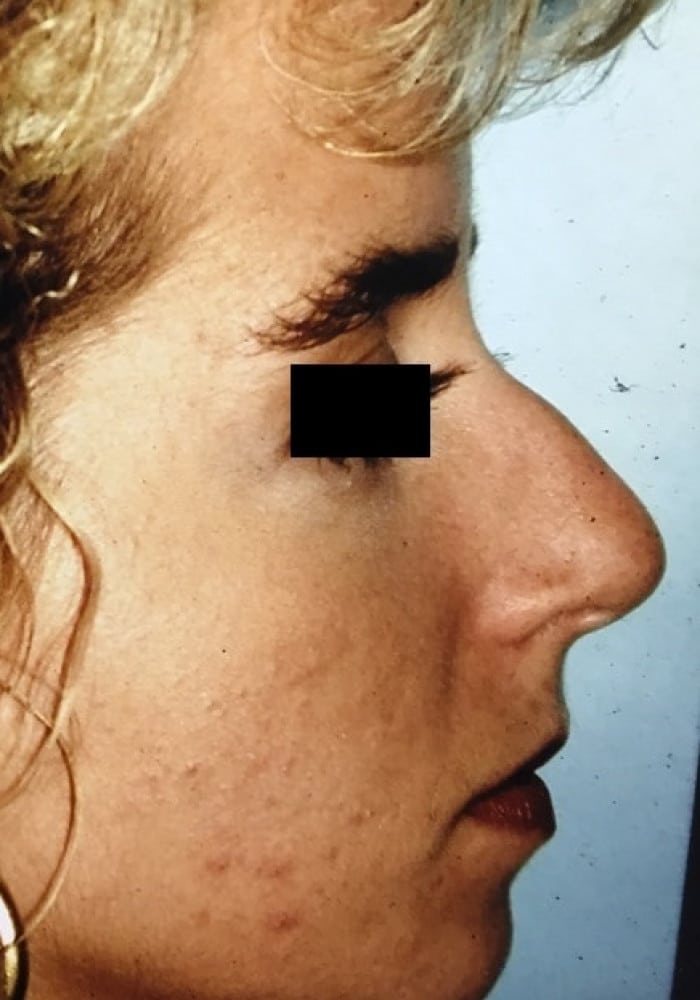 Before Image: Rhinoplasty - right-side