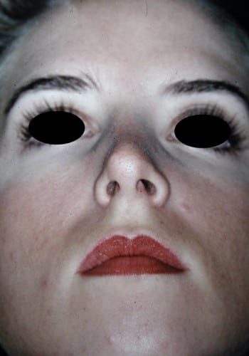 After Image: Rhinoplasty - front