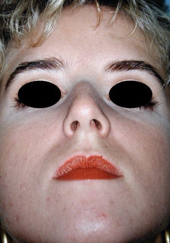 Before Image: Rhinoplasty - front