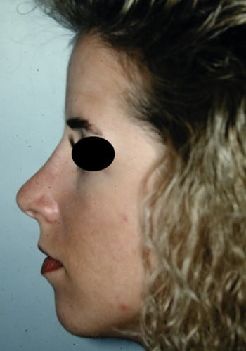 After Image: Rhinoplasty - left-side