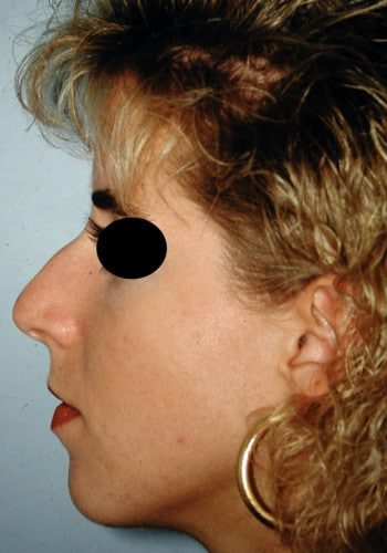 Before Image: Rhinoplasty - left-side