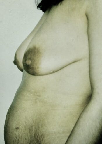 Before Image: Abdominoplasty & Mastopexy - left-side
