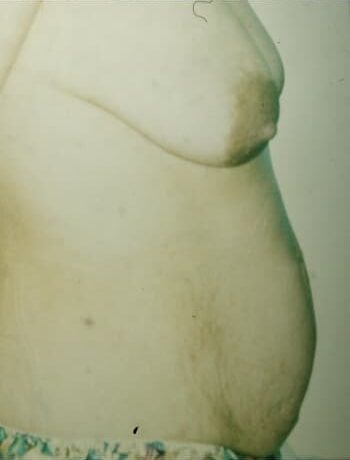 Before Image: Abdominoplasty & Mastopexy - right-side