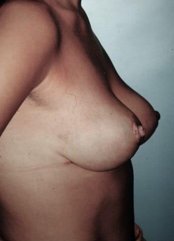 After Image: Breast Lift (Mastopexy) - right-side