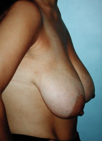 Before Image: Breast Lift (Mastopexy) - right-side
